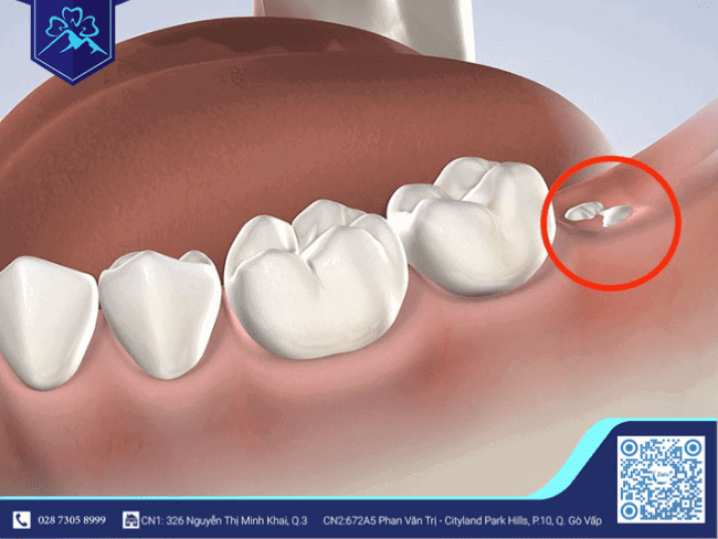 Ứng dụng công nghệ PRF trong nhổ răng khôn - ảnh 1