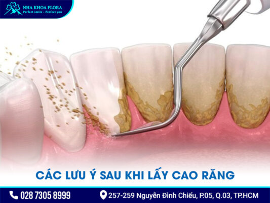 Lưu ý sau khi lấy cao răng - ảnh 1