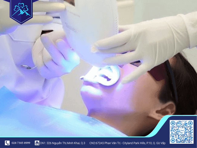 Khái niệm phương pháp tẩy trắng răng với công nghệ Plasma