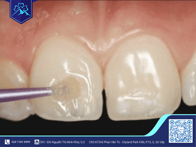 Men răng dễ bị hư tổn