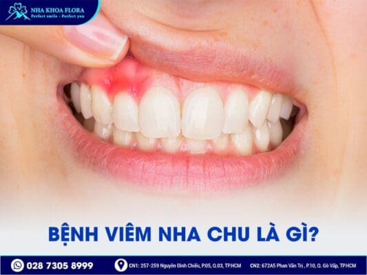 Viêm nha chu - ảnh 1