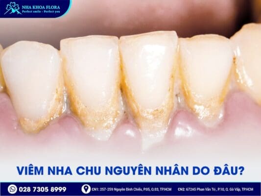 Viêm nha chu - ảnh 3