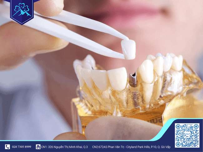 Răng tạm trên Implant