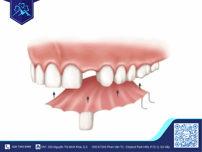 Răng tạm cố định