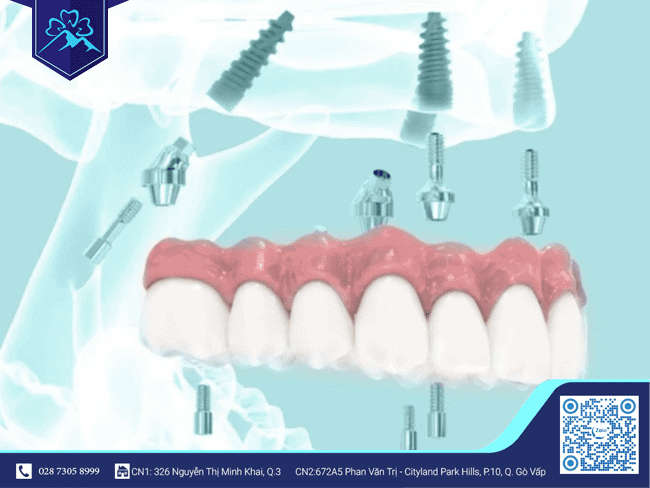 Implant sẽ có đủ khả năng chịu lực sang chấn 
