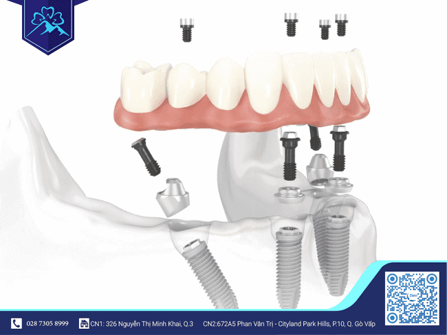 Trồng răng Implant khắc phục tình trạng mất răng liền kề