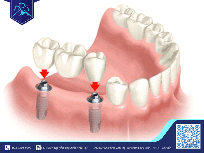 Mất 3 răng liền kề chỉ cần cấy 2 trụ Implant