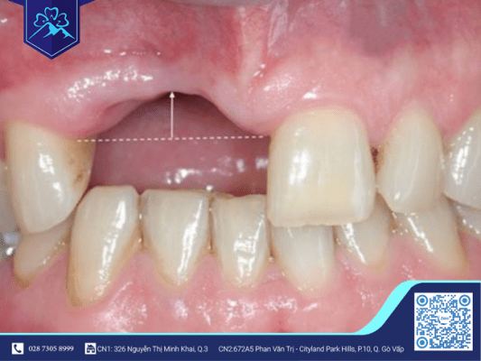 VÌ SAO MẤT 3 RĂNG LIỀN KỀ CHỈ CẦN CẤY 2 TRỤ IMPLANT? 1