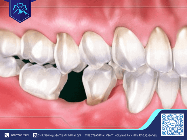 Nguyên nhân răng bị nghiêng