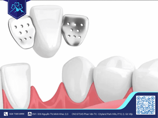 Răng tạm có cánh dán 