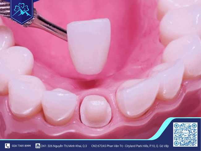 Bọc răng sứ 