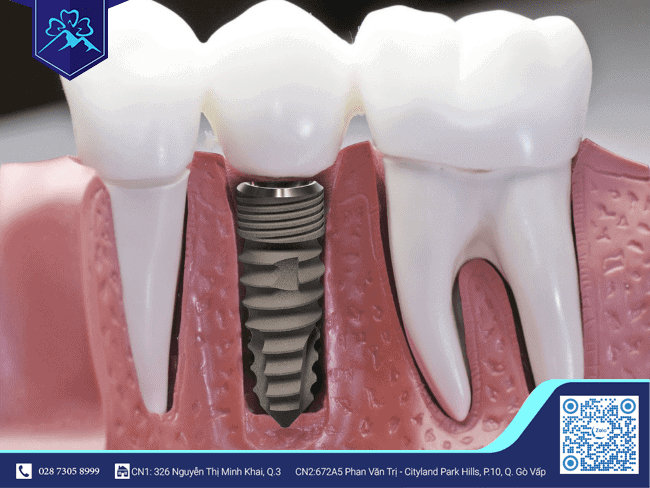 Trồng răng Implant đón tết