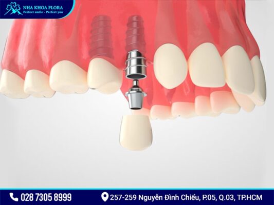 Sau khi sinh bao lâu thì trồng răng Implant được? - ảnh 1