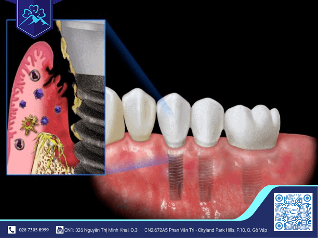 Triệu chứng nhiễm trùng sau khi cấy ghép Implant