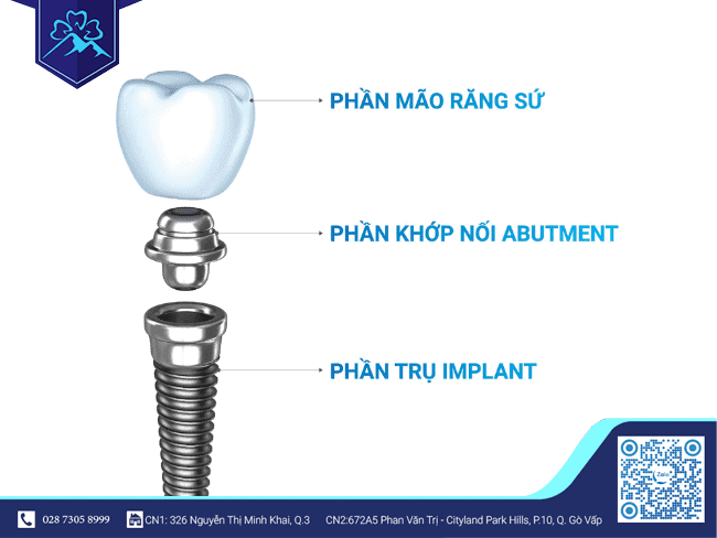 Cấu tạo của răng Implant