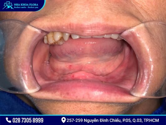 Implant All On 4 và All On 6 - ảnh 1