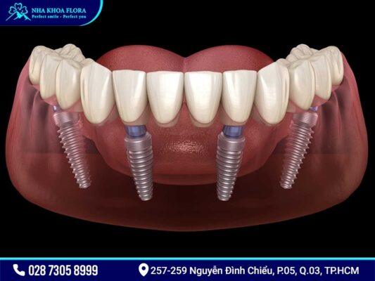 Implant All On 4 và All On 6 - ảnh 2