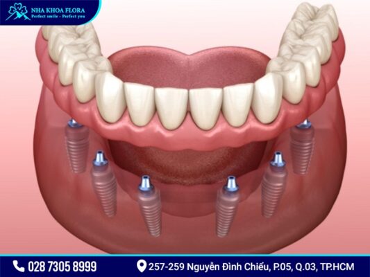 Implant All On 4 và All On 6 - ảnh 3
