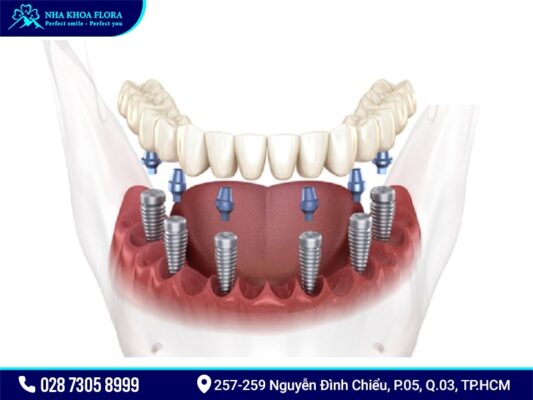 Implant All On 4 và All On 6 - ảnh 4