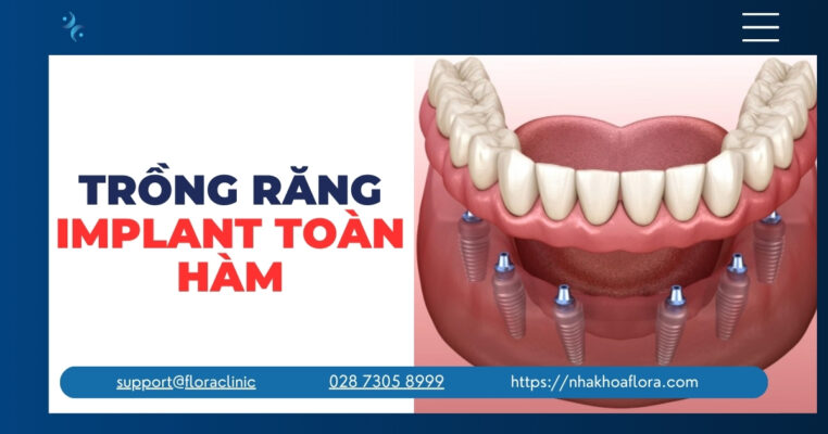 Implant All On 4 và All On 6