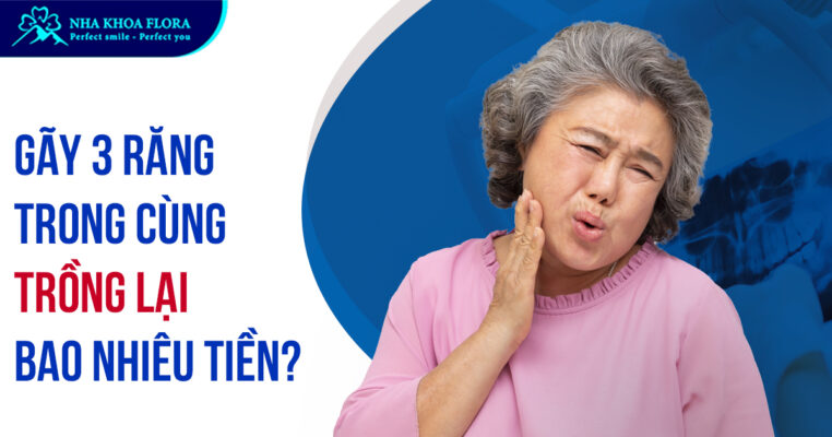 Gãy 3 răng trong cùng