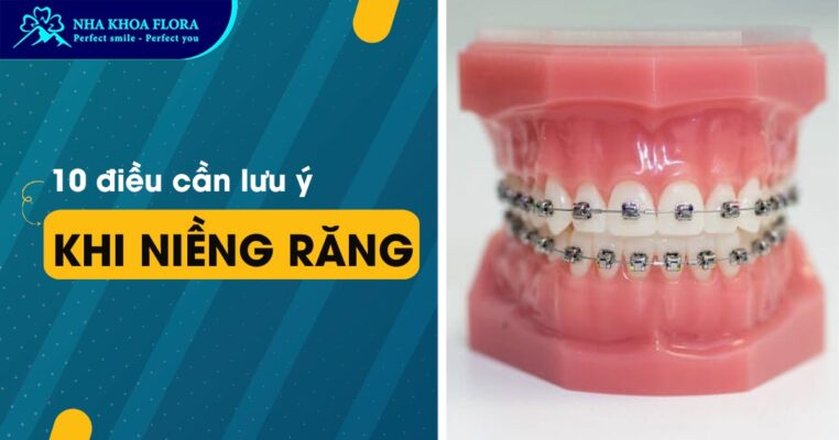 lưu ý khi niềng răng