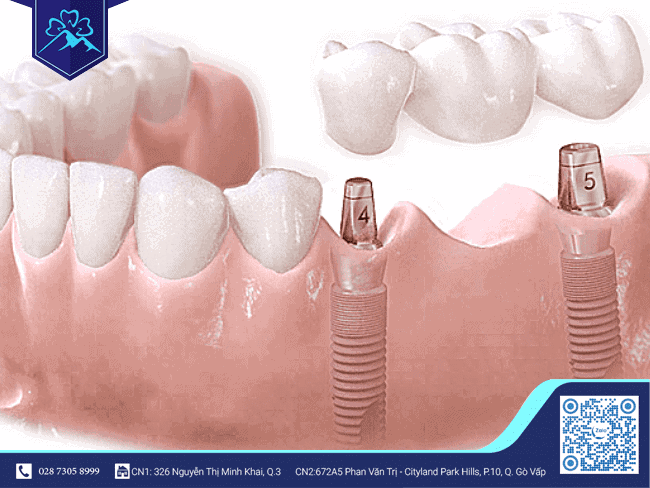 Có thể thay mới răng sứ trên Implant