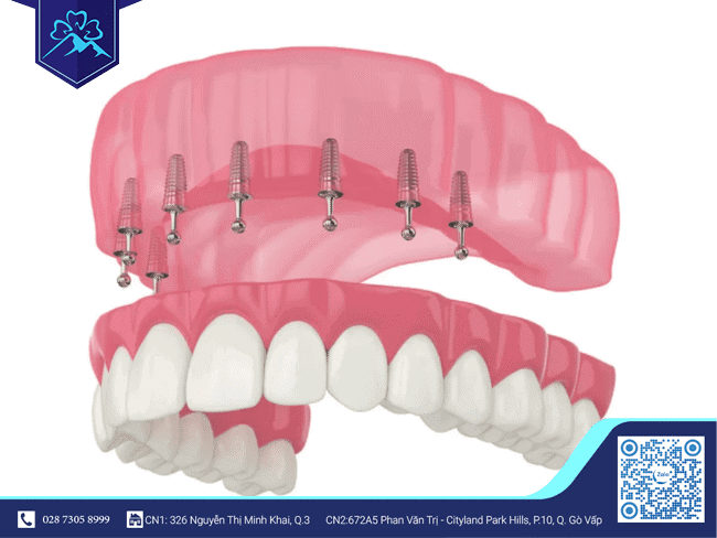 Cấu tạo của trụ Implant