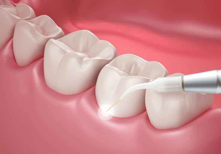 Ứng Dụng Laser Trong Cấy Ghép Implant 2