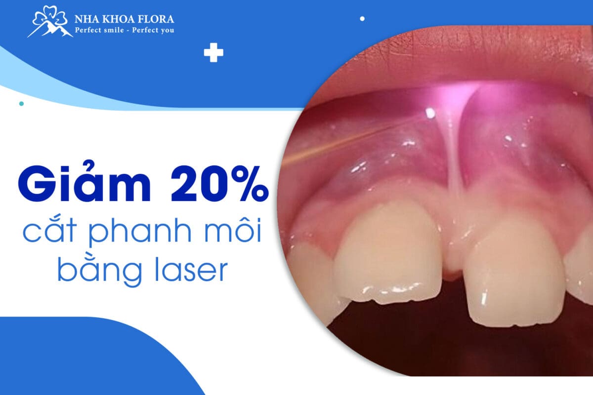 răng cửa thưa do dính phanh môi