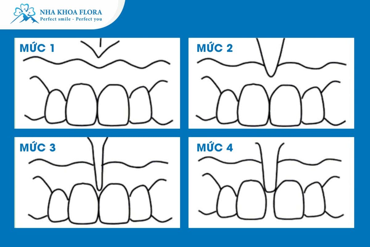 Dính phanh môi là một trong những nguyên nhân gây ra tình trạng răng cửa thưa
