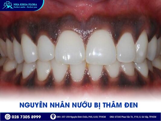 làm hồng nướu bằng Laser - ảnh 1