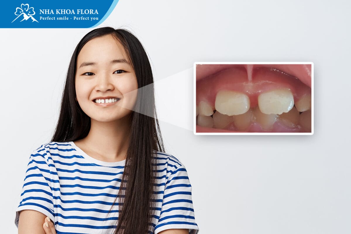 Điều trị răng cửa thưa do dính phanh môi