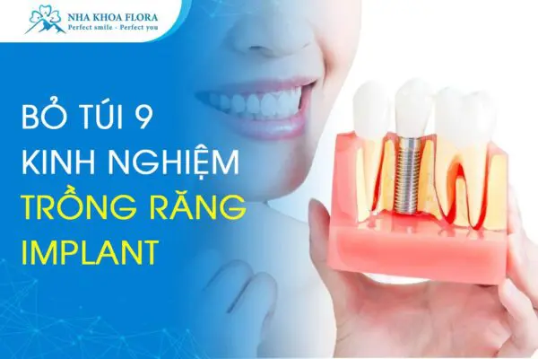 Bỏ Túi 9 Kinh Nghiệm Trồng Răng Implant Hiệu Quả 3