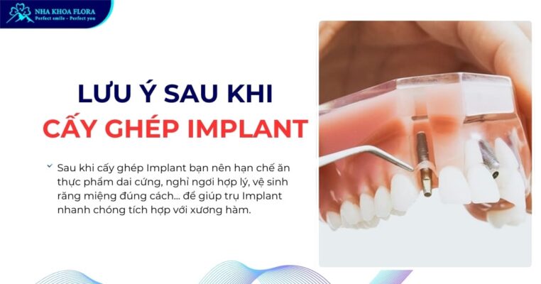 lưu ý sau khi cấy ghép implant