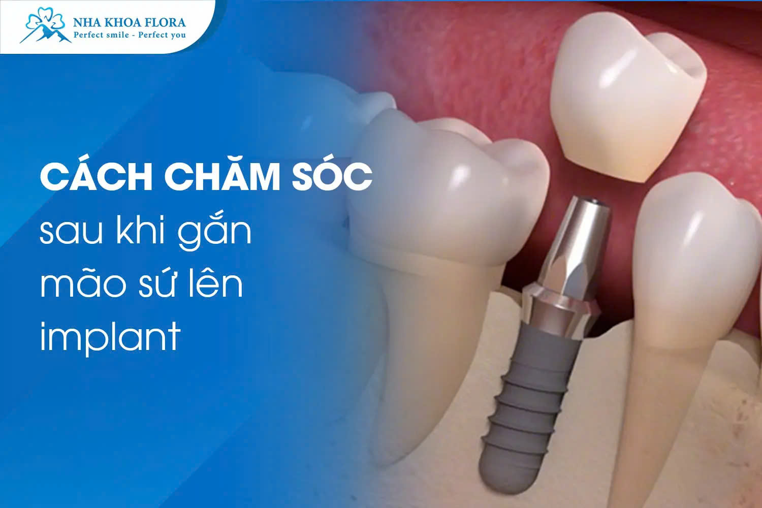 lưu ý sau khi cấy ghép implant