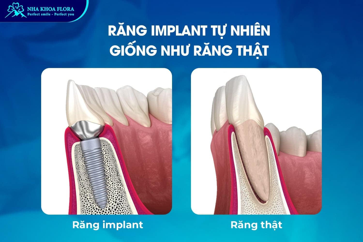 [Hỏi Đáp]: Sau Khi Nhổ Răng Bao Lâu Thì Trồng Implant? - ảnh 1