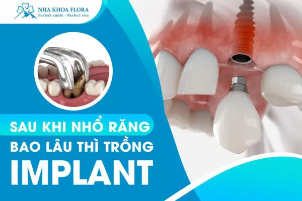 [Hỏi Đáp]: Sau Khi Nhổ Răng Bao Lâu Thì Trồng Implant? 1
