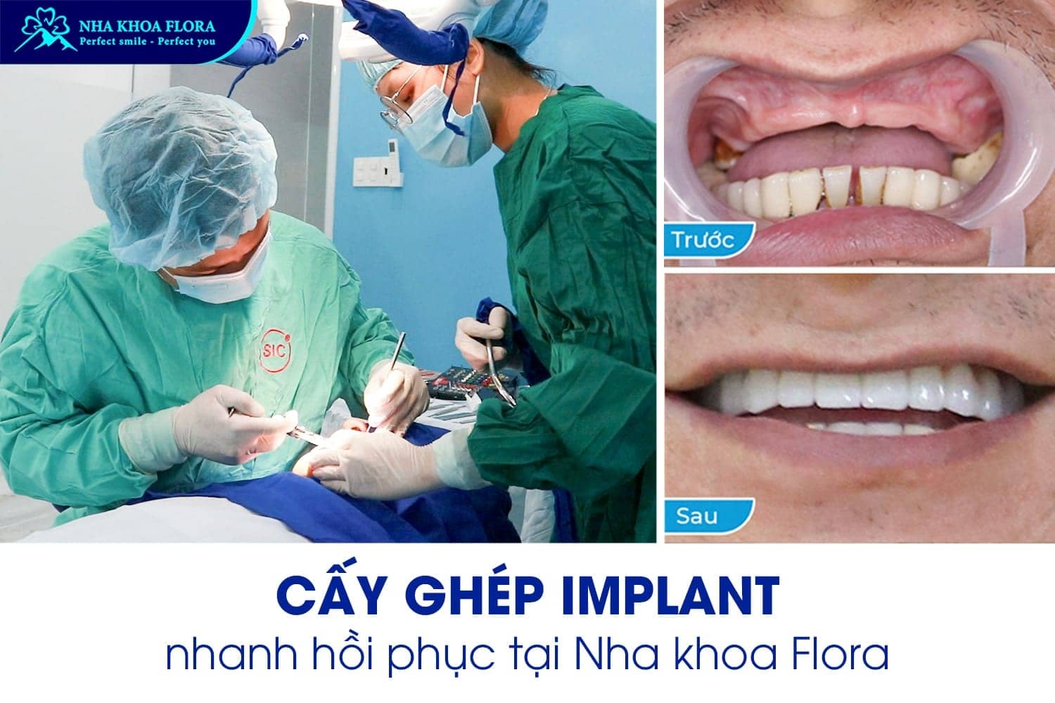 Hỏi Đáp: Trồng Răng Implant Bao Lâu Thì Lành? - ảnh 5