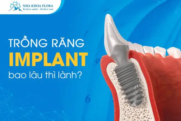 Hỏi Đáp: Trồng Răng Implant Bao Lâu Thì Lành? 4