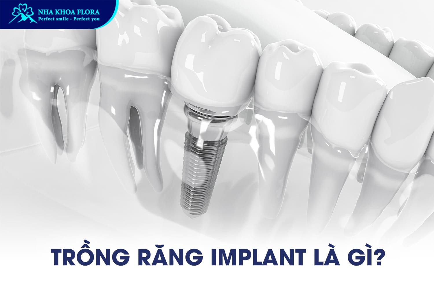Trồng Răng Implant Có Niềng Răng Được Không? - ảnh 1