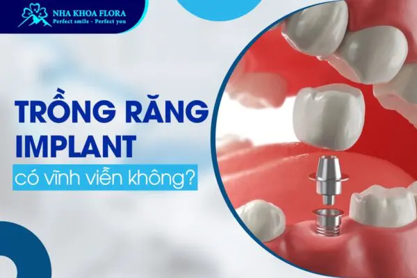 Hỏi Đáp: Trồng Răng Implant Có Vĩnh Viễn Không? 2