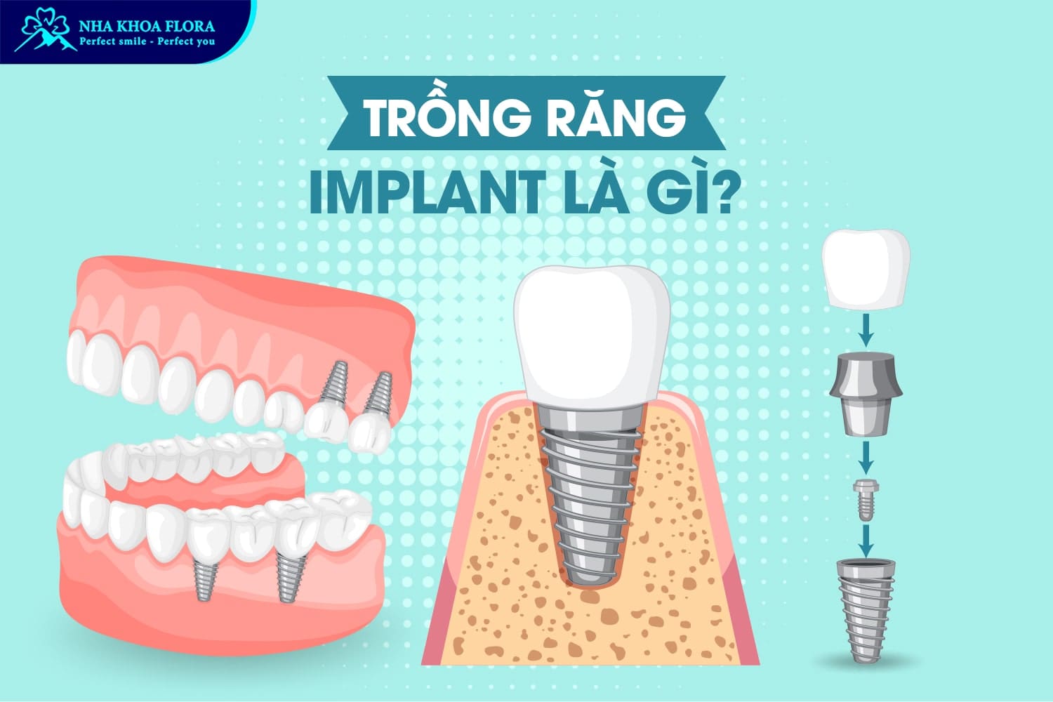 Trồng Răng Implant Là Gì? 10 Điều Cần Biết Trước Khi Thực Hiện - ảnh 1