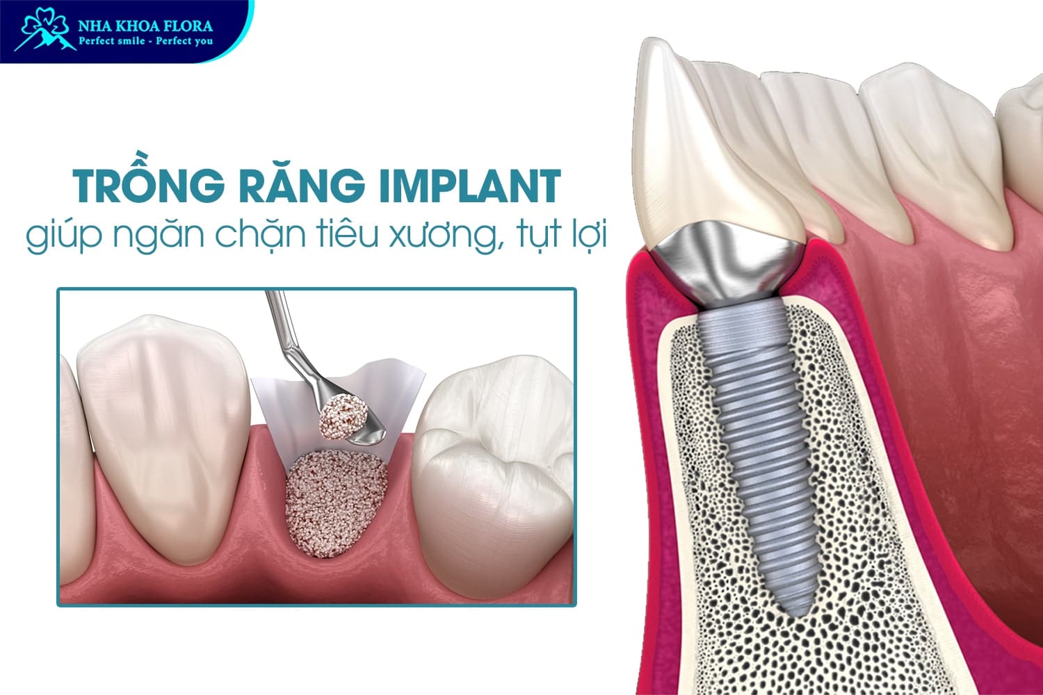 Trồng Răng Implant Là Gì? 10 Điều Cần Biết Trước Khi Thực Hiện - ảnh 3