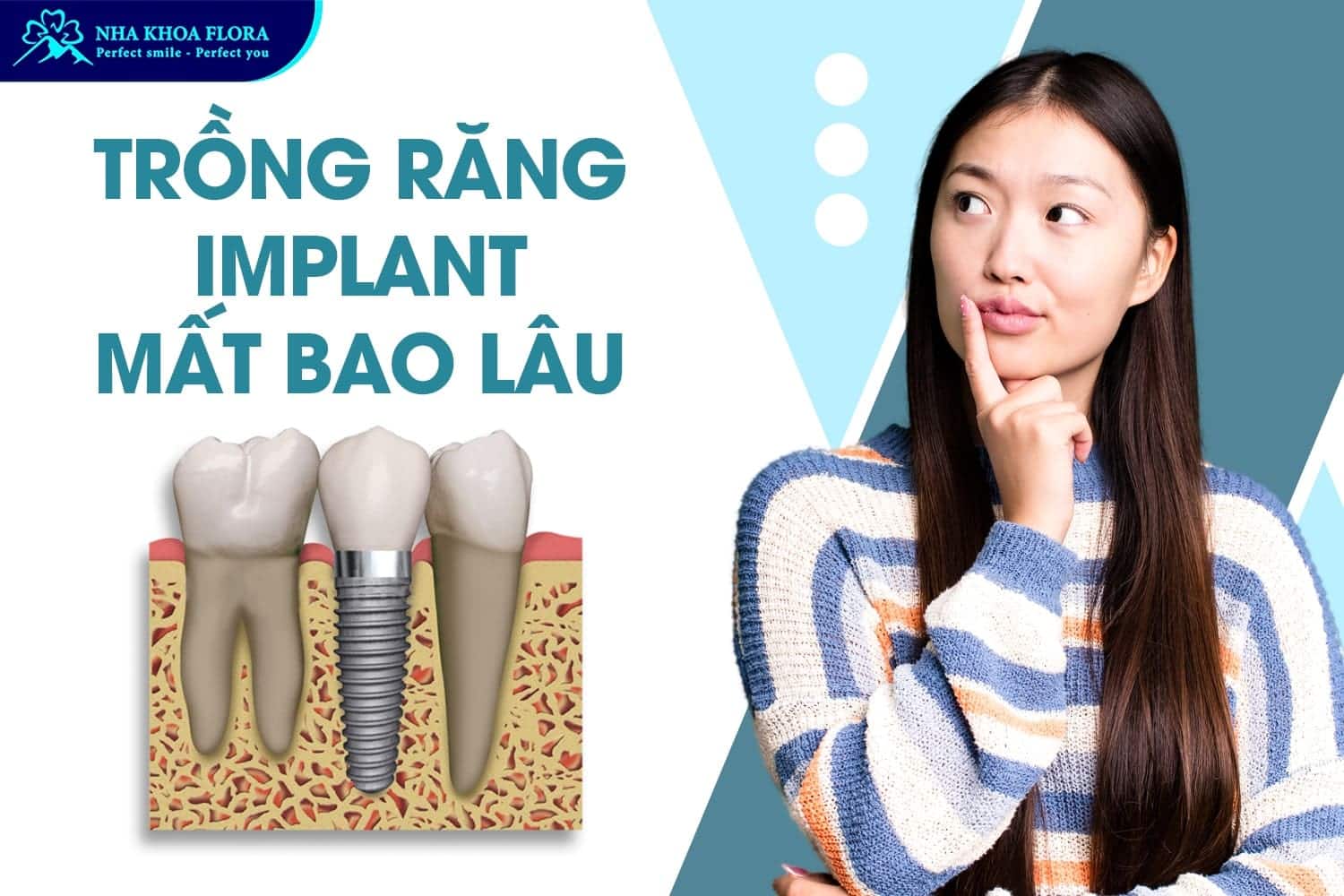 Trồng Răng Implant Là Gì? 10 Điều Cần Biết Trước Khi Thực Hiện - ảnh 4