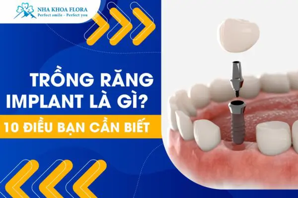 Trồng Răng Implant Là Gì? 10 Điều Cần Biết Trước Khi Thực Hiện 6