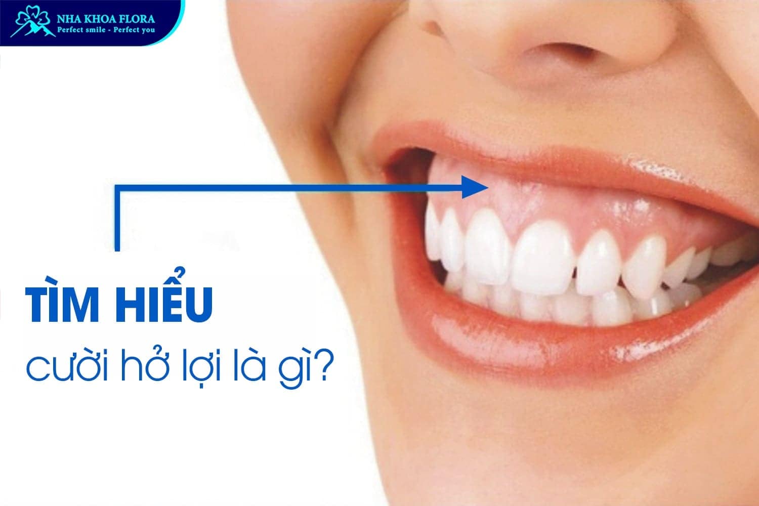 Bỏ Túi 8 Cách Cười Không Hở Lợi Đơn Giản Nhất - ảnh 1