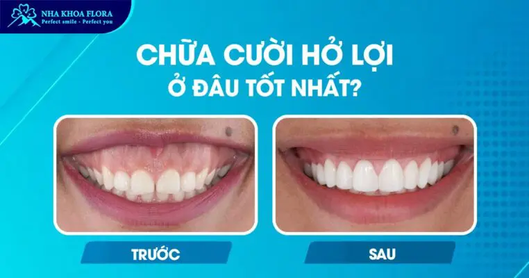 Chữa Cười Hở Lợi Ở Đâu Tốt Nhất Tại TP.HCM? 1