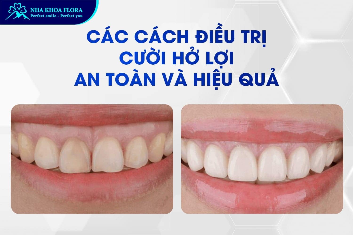 Con Gái Cười Hở Lợi Phải Làm Sao? Tướng Số Thế Nào? - ảnh 4