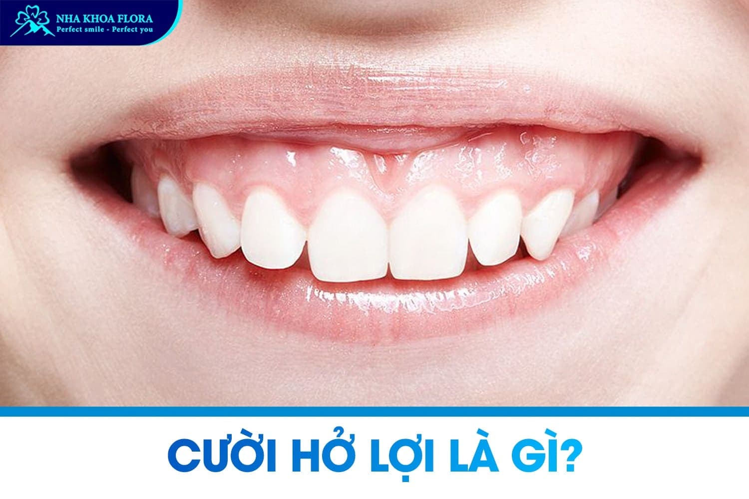 Cười Hở Lợi Là Gì? Nguyên Nhân Và Cách Khắc Phục Hiệu Quả - ảnh 1